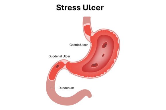 Stress Ulcer in Stomach and Duodenum